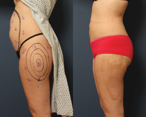 Different liposuction methods'