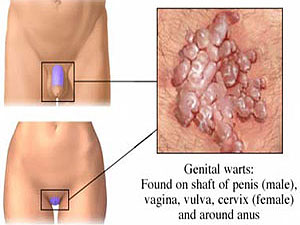 Genital Warts'