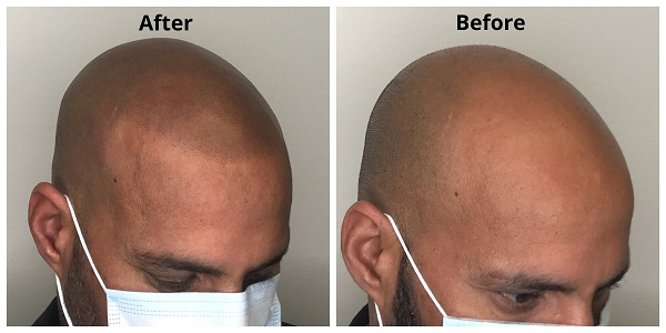 Company Logo For Chroma Clinic Scalp Micropigmentation'