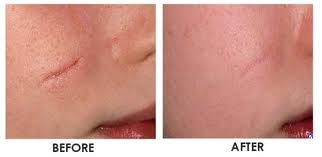 Scar Cream'