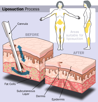 Liposuction Surgery In 2013'