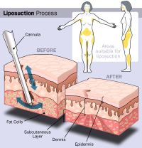Liposuction Surgery In 2013