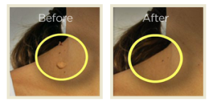 Skin Tag Removal'