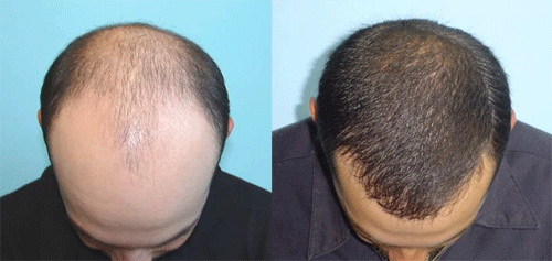 Provillus Hair Loss'