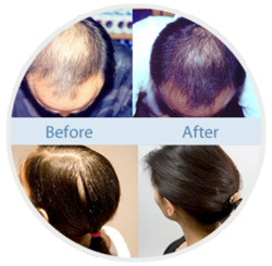 Provillus Before After'