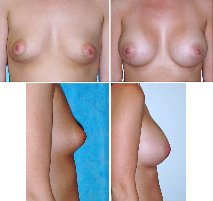 Breast Augmentation: Is It Worth It?'