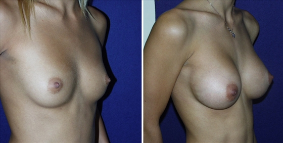 Breast Augmentation: Is It Worth It?'