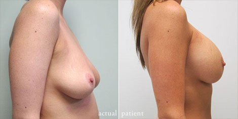 Breast Augmentation: Is It Worth It?'