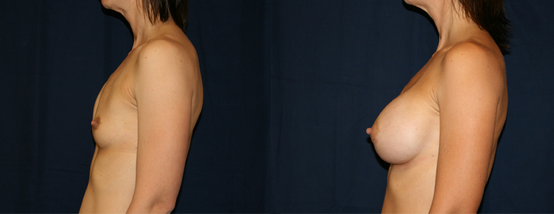 Breast Implants: A Good Choice?'