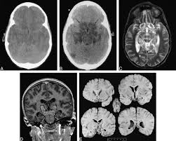 Brain Edema Treatment'