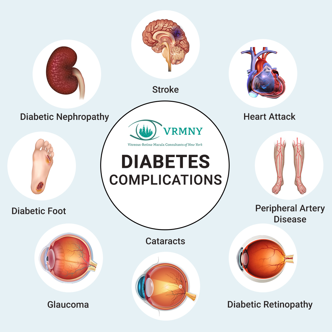 Complications of diabetes'