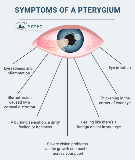 Symptoms of Pterygium'