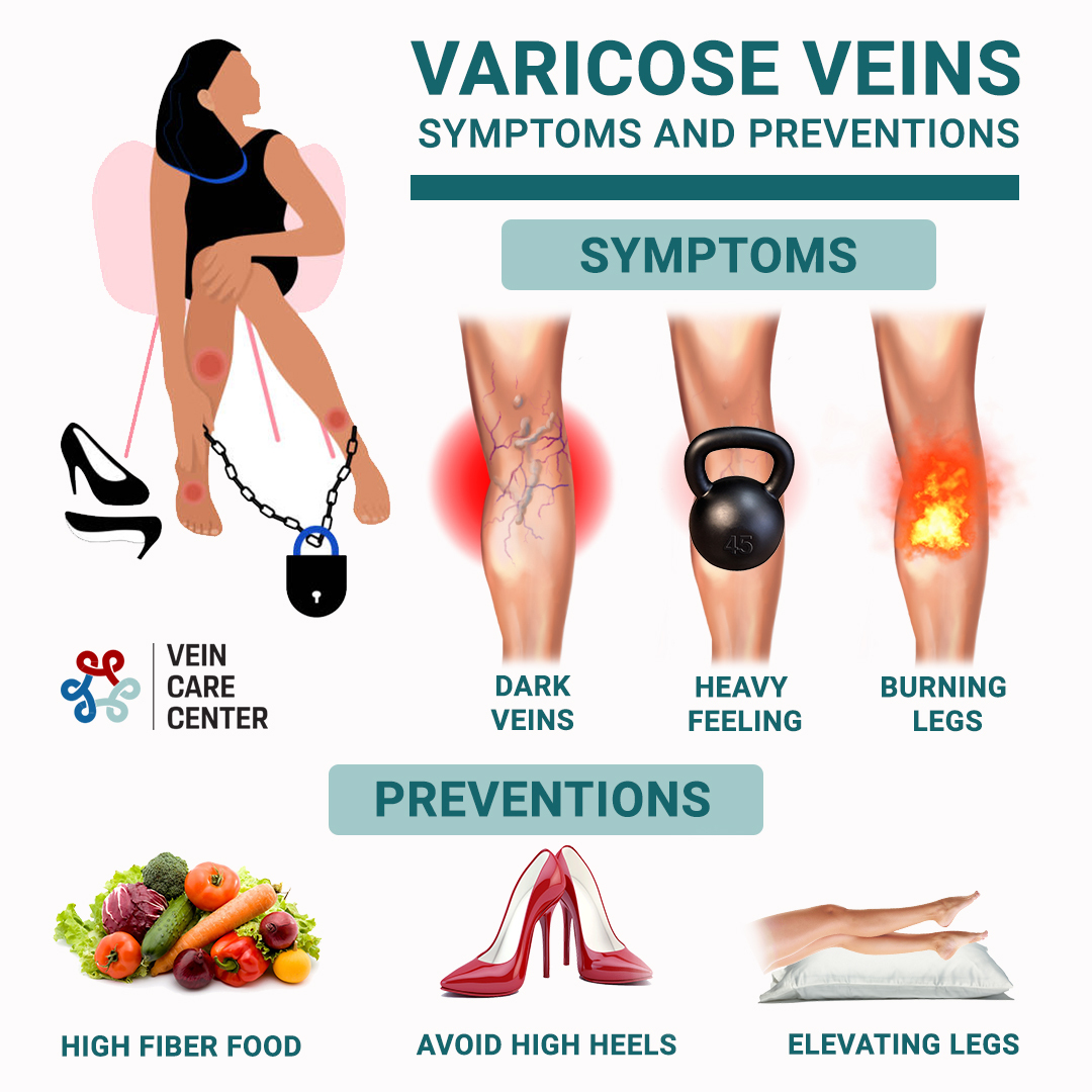 varicose veins symptoms and preventions'
