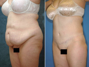 Tummy Tuck And Its Effect On People'
