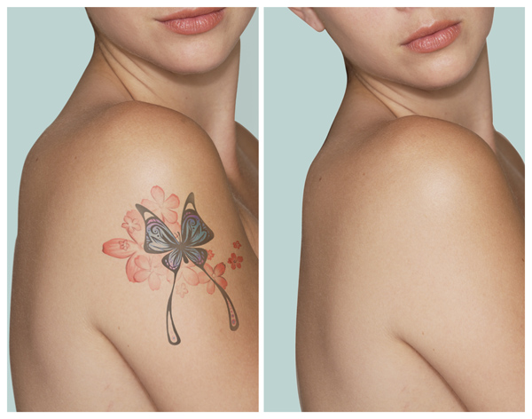 Tattoo Removal'