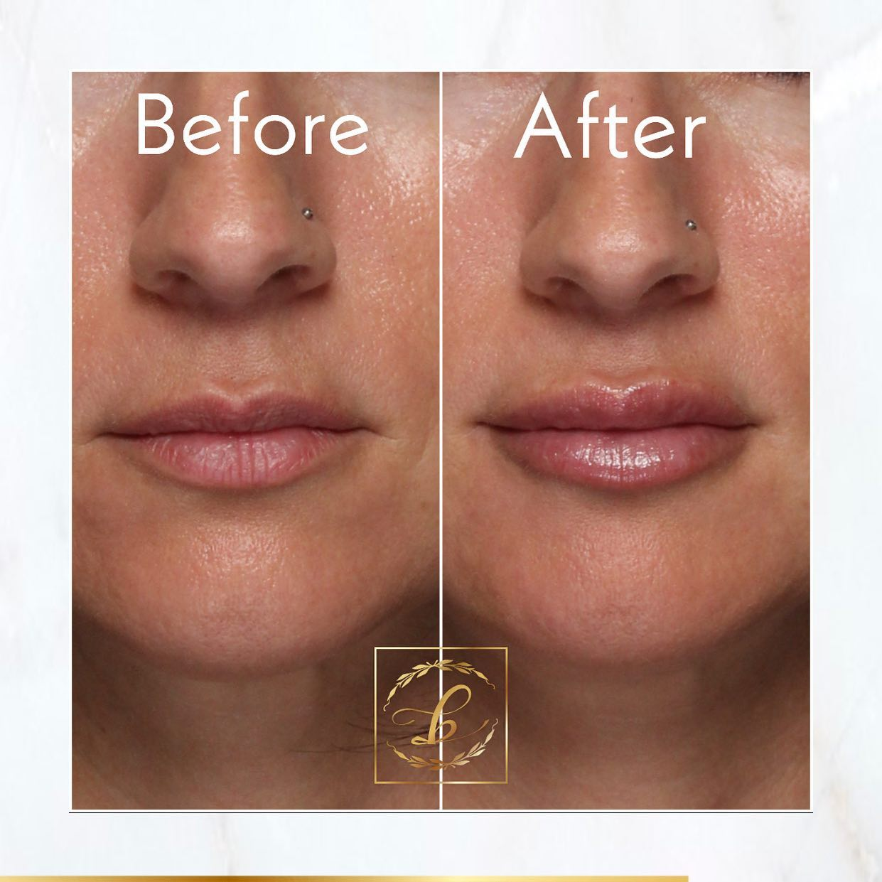 Botox Newport Beach'