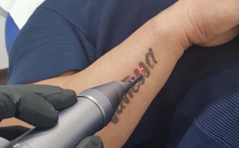 Tattoo Removal Machine Market'