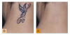 Why Are People Going For A Tattoo Removal Option'