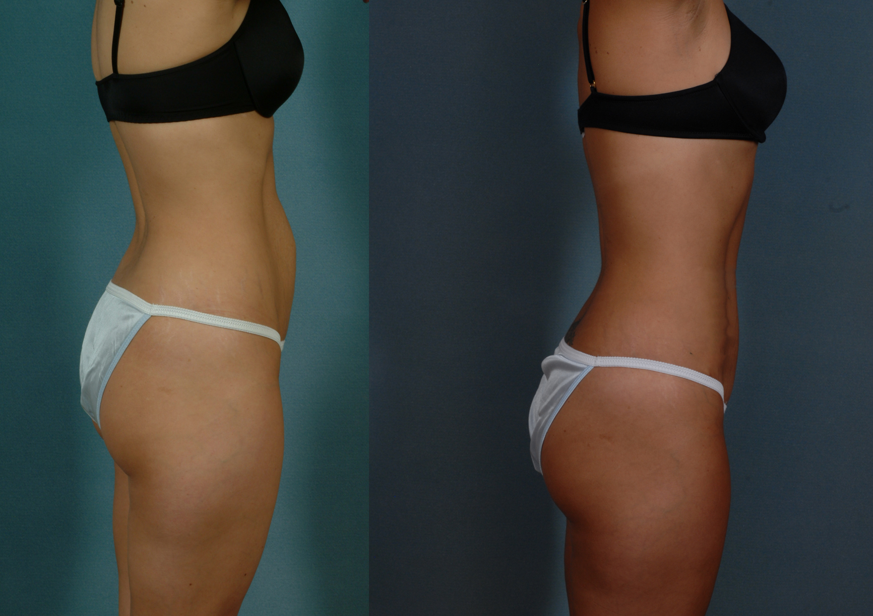 Time for Tummy Tuck- Say No to Jelly Belly'