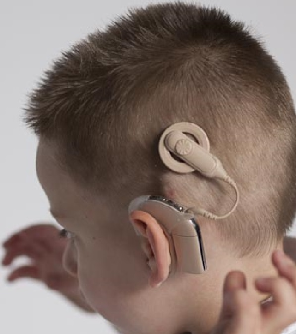Hearing Implants Market
