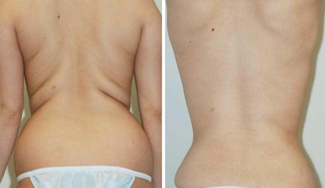 liposuction2'