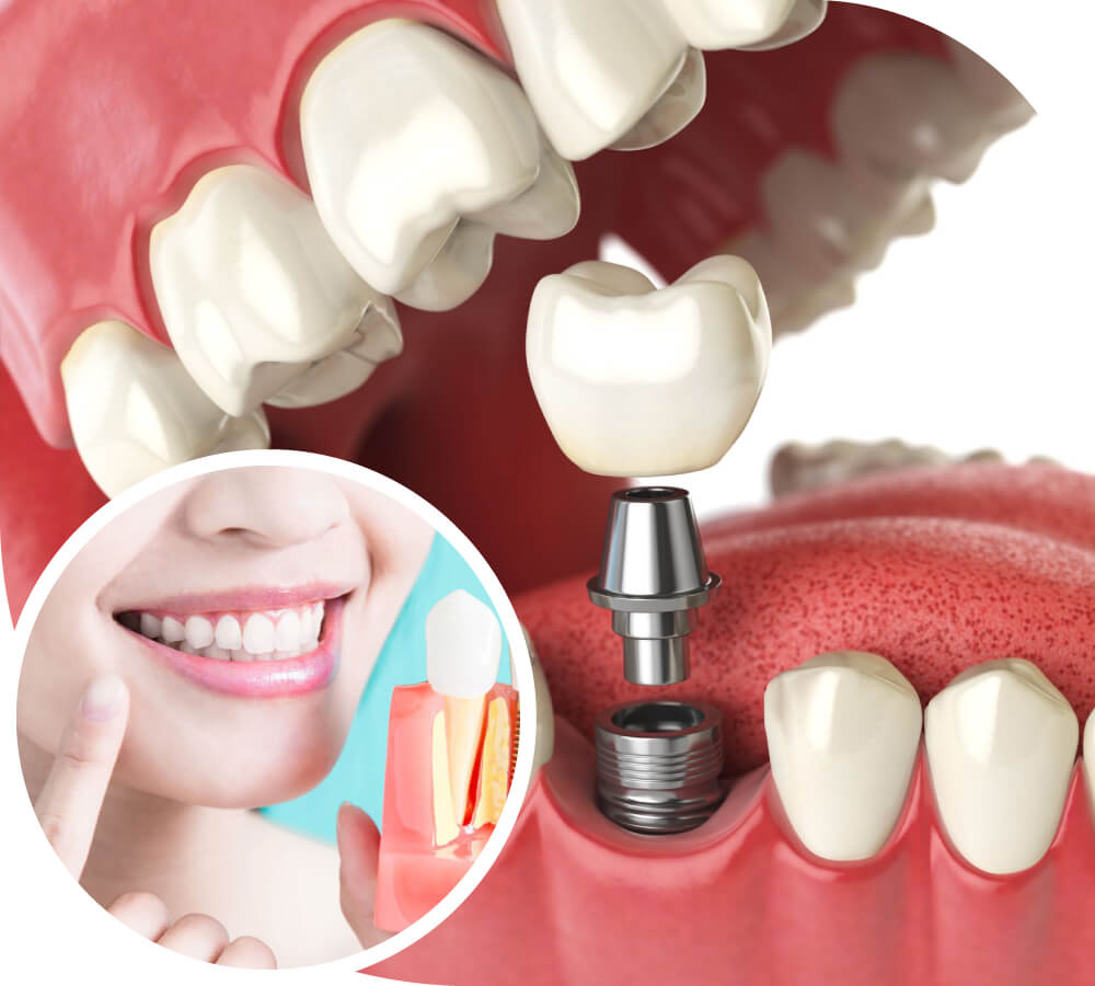 Dental Implants'