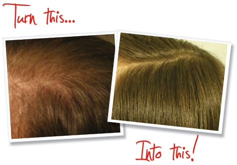 Provillus Hair Loss'