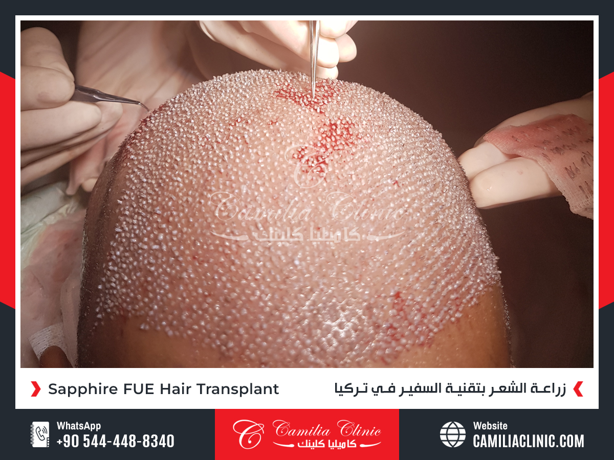 Company Logo For Camilia Clinic Hair Transplant in Turkey'