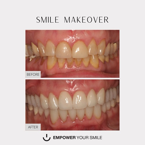 Smile Makeovers'