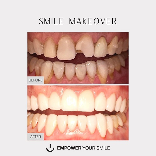 Teeth Whitening'