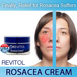 Rosacea Treatment Cream'