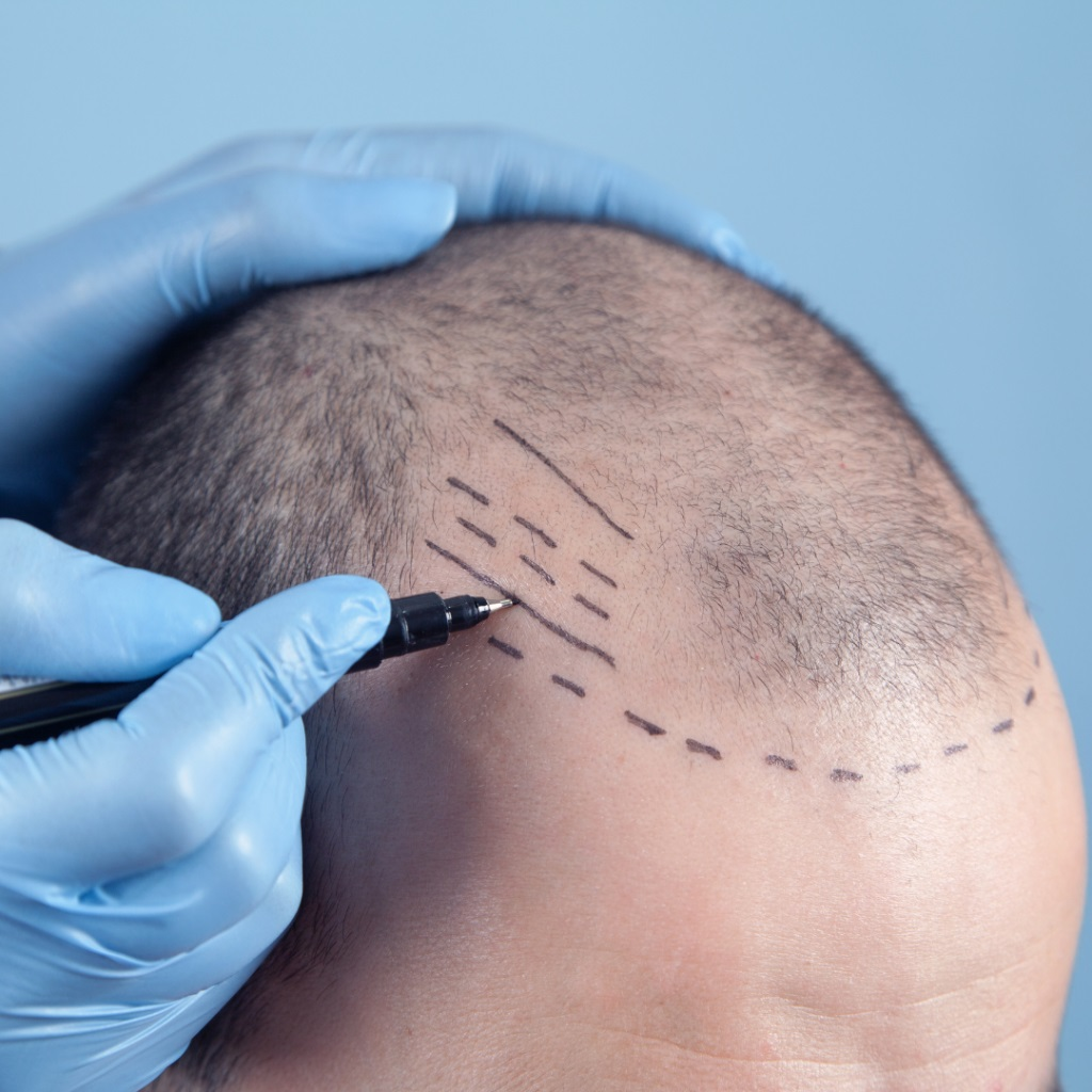 Maryland Hair Transplant'