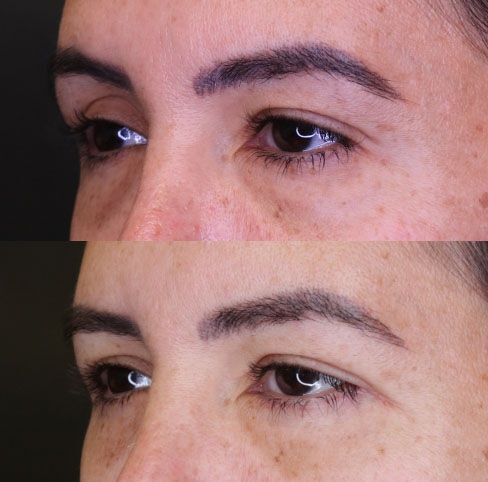 Blepharoplasty'