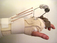 Lisa Copen's Outrigger Splint Following 4 Joint Replacements