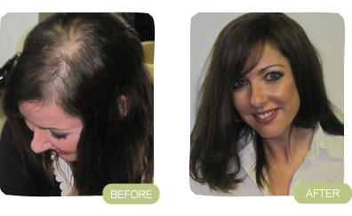 Provillus Hair Loss'