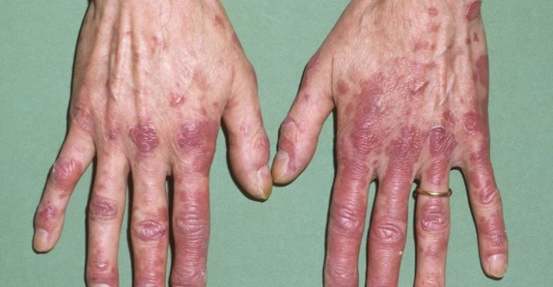 Lupus Erythematosus Treatment Market