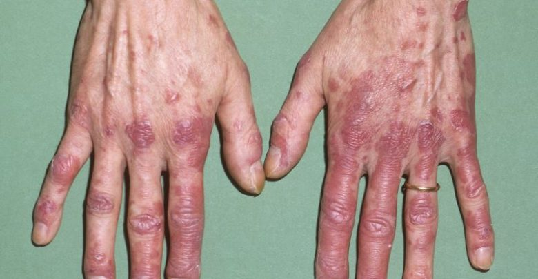 Lupus Erythematosus Treatment Market'