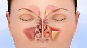 Sinusitis market'