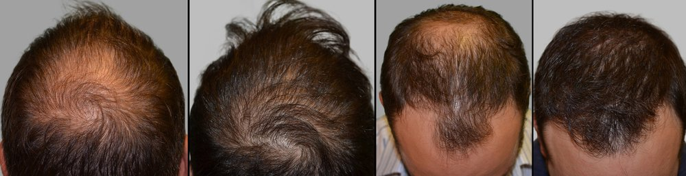 Newport Beach Hairline Restoration'