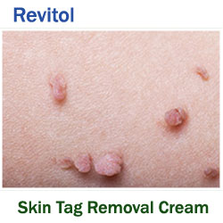 Revitol Skin Tag Removal'