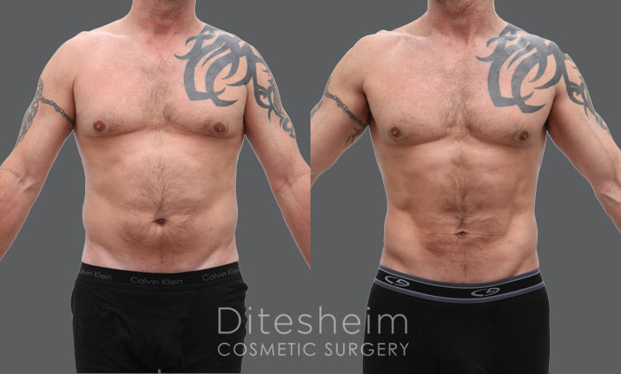 Liposuction Charlotte NC'