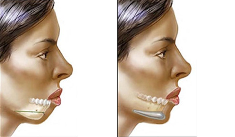 Cheek and Chin Implants Market
