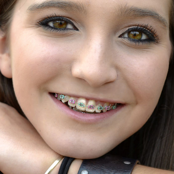 Braces'