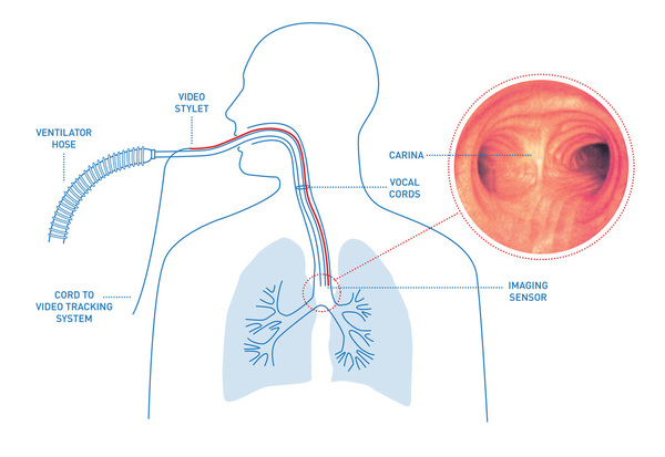 Airway Monitoring System'