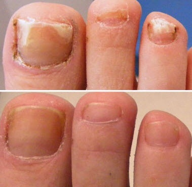 Nail Fungus Treatment'