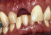 Implant Before'