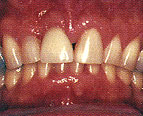 Implant After'