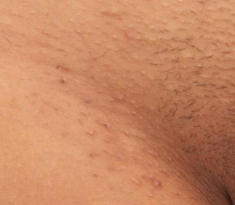 Ingrown Hair Removal Treatment Special Offered At Manhattan Ny