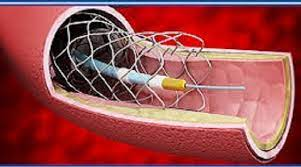 Peripheral Vascular Devices Market