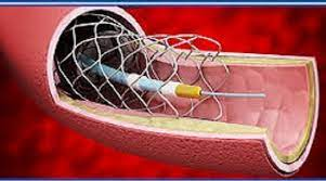 Peripheral Vascular Devices Market'